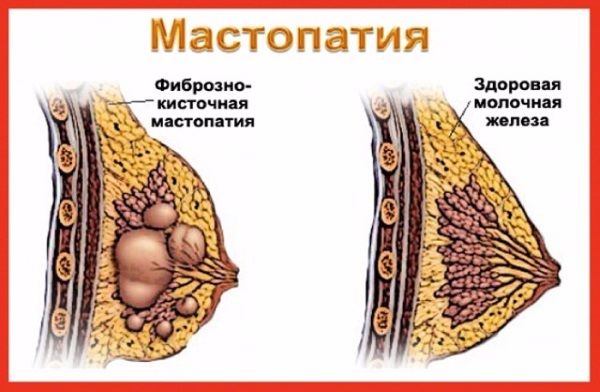 Как болит грудь при беременности на ранних сроках, во втором, третьем триместре. Когда начинает, перестает, как меняются железы