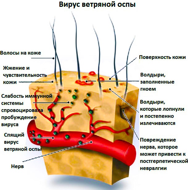 Как выглядит оспа фото