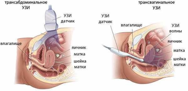 Цервикометрия при беременности. Что это, как делают УЗИ шейки матки