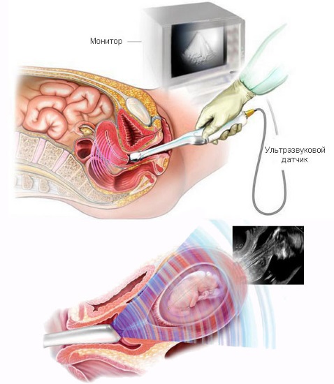 Цервикометрия при беременности. Что это, как делают УЗИ шейки матки