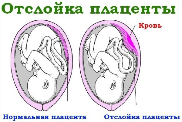 2 замершие беременности подряд что делать отзывы врачей